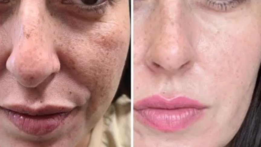 לפני אחרי אא